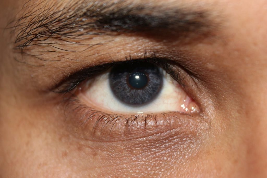 Patient Photos - IrexLaser: Permanent eye color change