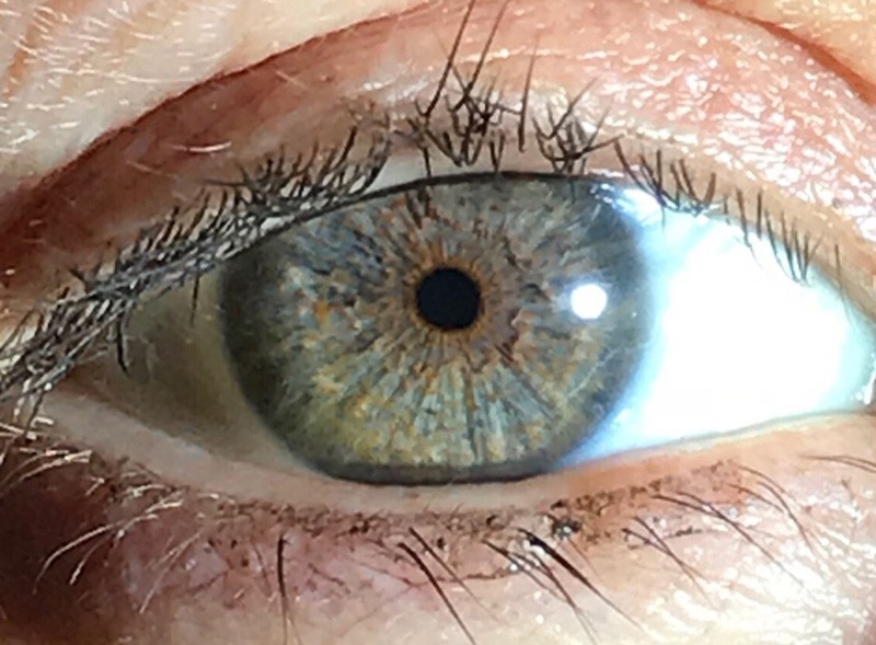 IrexLaser permanent eye Color change technology