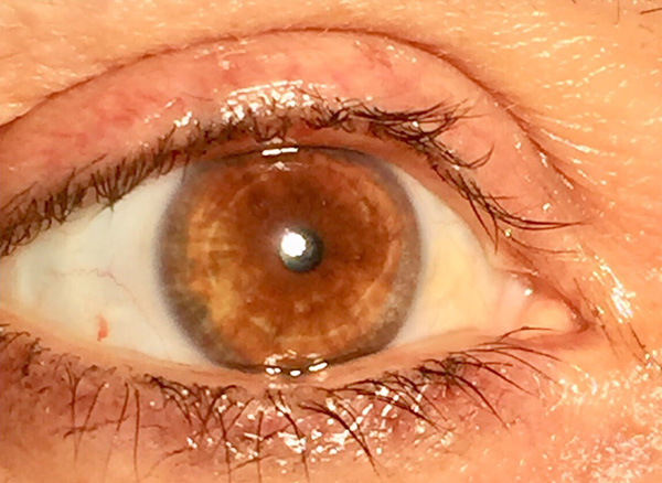 laser eye color change results