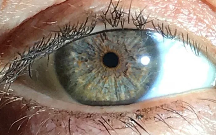 poltnext.blogg.se - Yellow ring around iris of eye